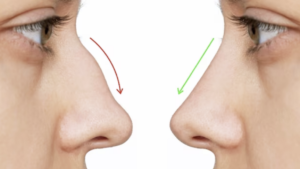 Rhinoplasty in Dubai Abu Dhabi | Nose Job