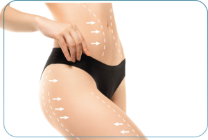 Liposuction Abu Dhabi | Vaser Liposuction Dubai