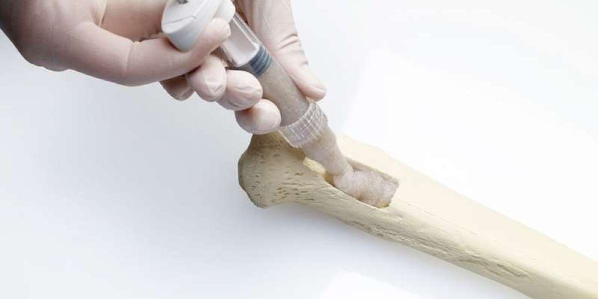 The Future of Bone Repair: Bioactive Substitutes and 3D Printing Lead the Way