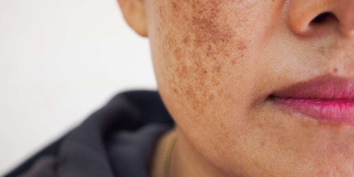 Hyperpigmentation Disorder Treatment Market Industry Trends, Share and Future Growth 2030