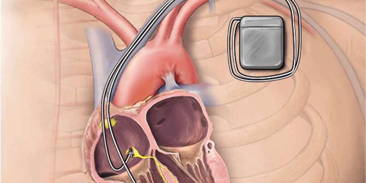 Implantable Cardioverter Defibrillators Market Industry Trends, Share and Future Growth 2031