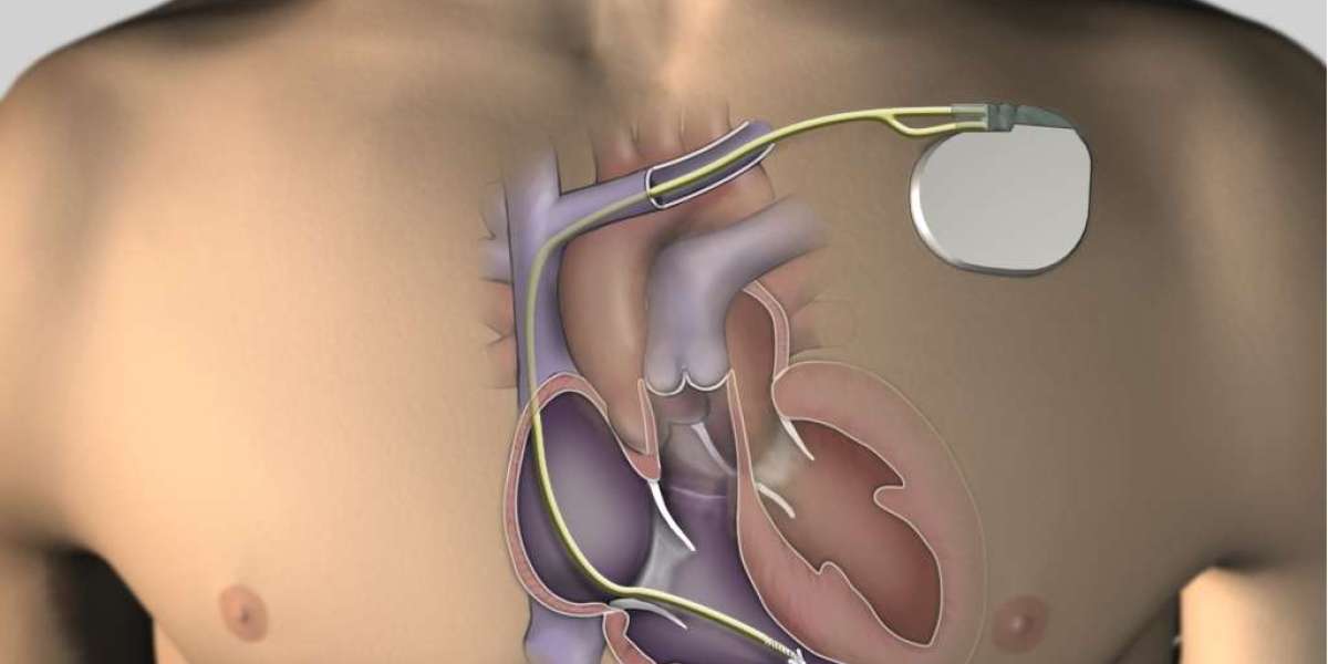 Artificial Cardiac Pacemaker Market Size, Status and Forecast by 2031