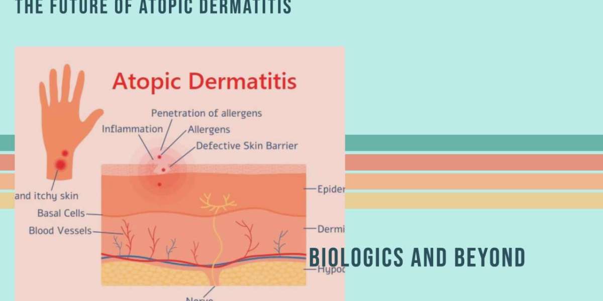 Atopic Dermatitis Breakthroughs: Sanofi, Novartis Leading the Way