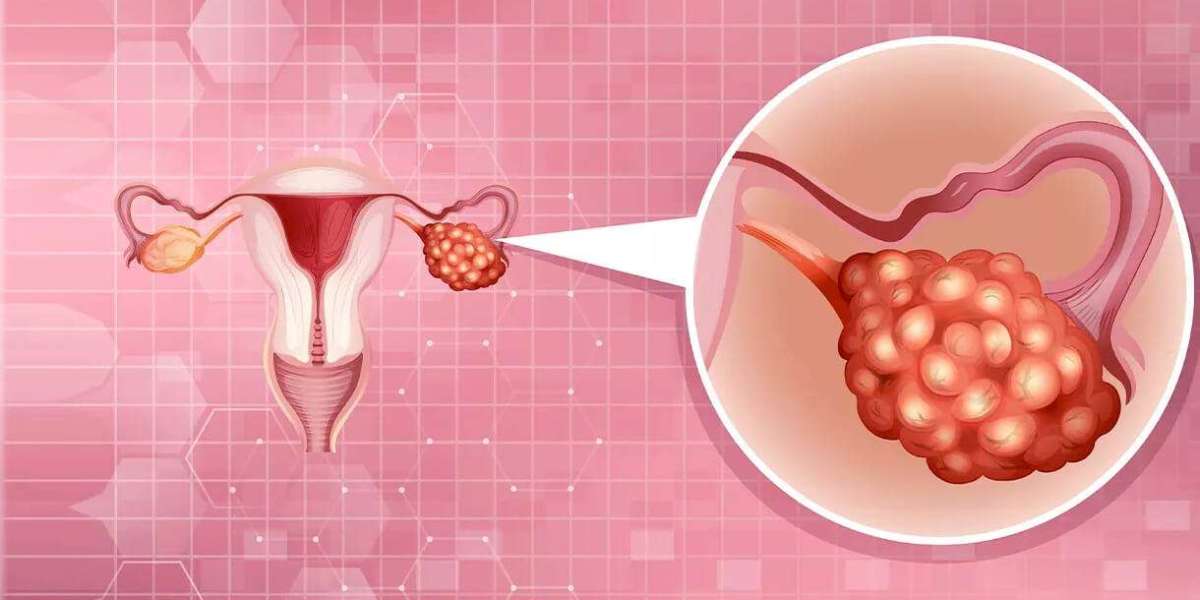 Johnson & Johnson's Innovative Solutions for Ovarian Cyst Management: Market Insights and Future Growth