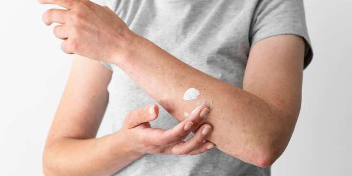 Preventing Eczema Flare-ups: Lifestyle Tips and Tricks