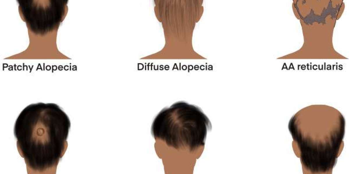 Alopecia Areata Market Share, Epidemiology, Analysis & Trends 2024-2034