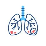 Lung Cancer Treatment