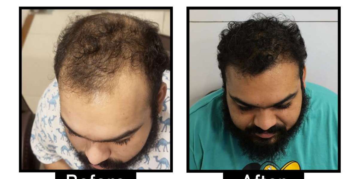 Hair Transplantation in Delhi: Expert Solutions for Hair Loss from