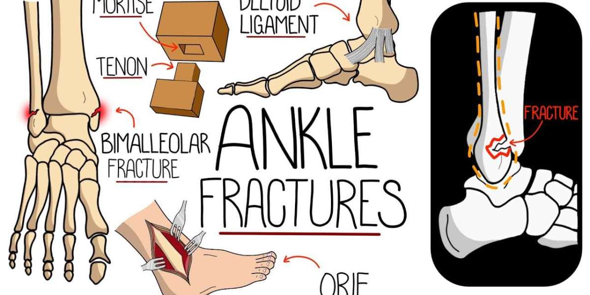 Comprehensive Guide to Ankle Fracture Treatment in Lahore: What You Need to Know