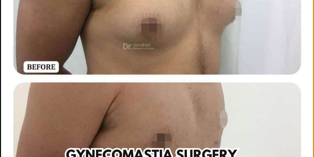 Everything You Need To Know About Gynecomastia Surgery