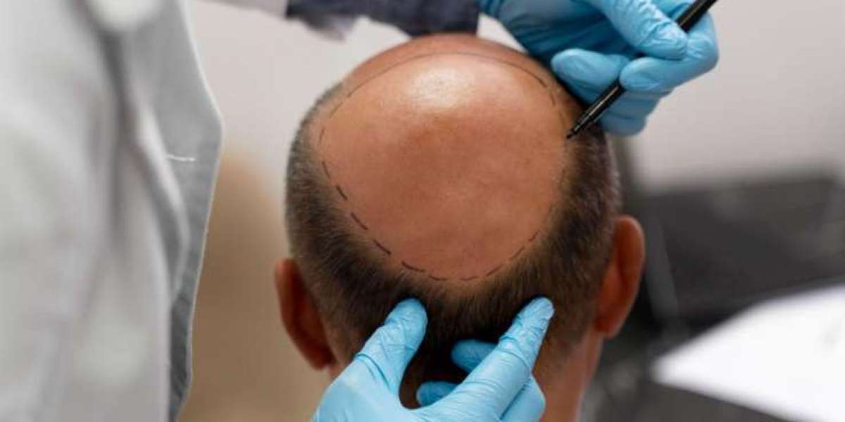 How To Prepare Yourself For Hair Transplant Surgery?