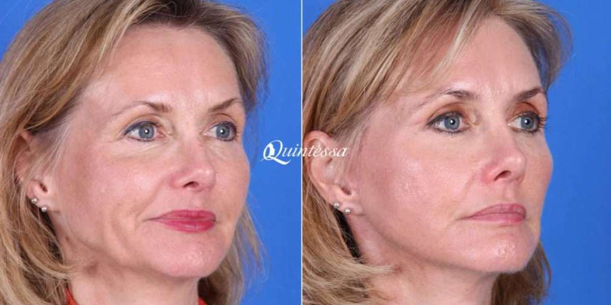 Finding the Best Facelift Surgeon in Fort Myers