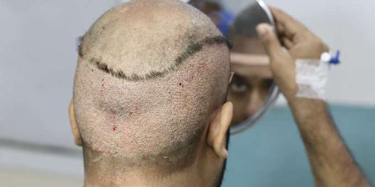 Best hair transplant in Jodhpur