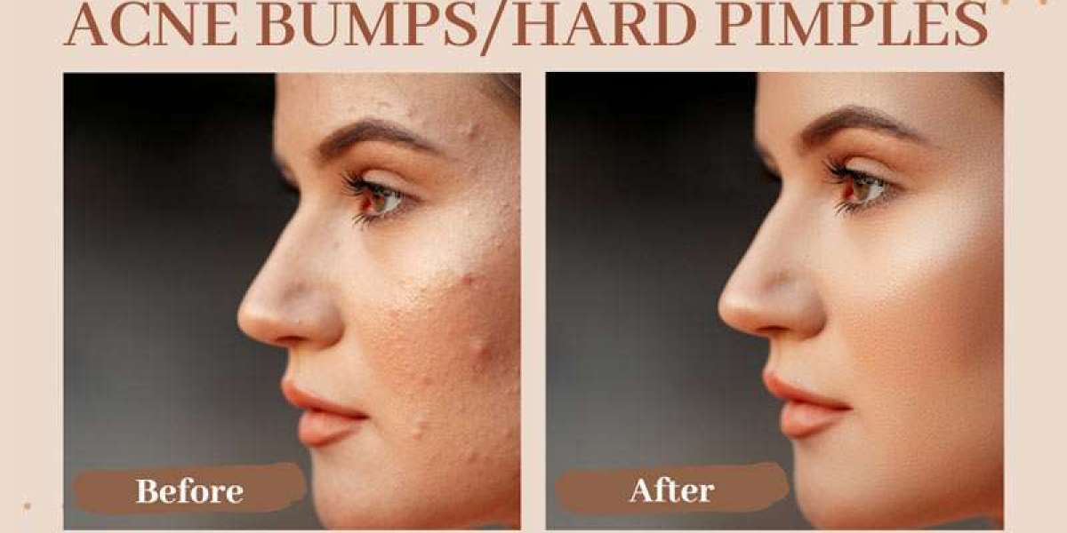 How Do You Get Rid of Pimples? A Complete Guide to Clear Skin