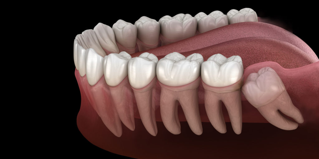 Tooth Extractions Louisville, KY | Advanced Implant Centers