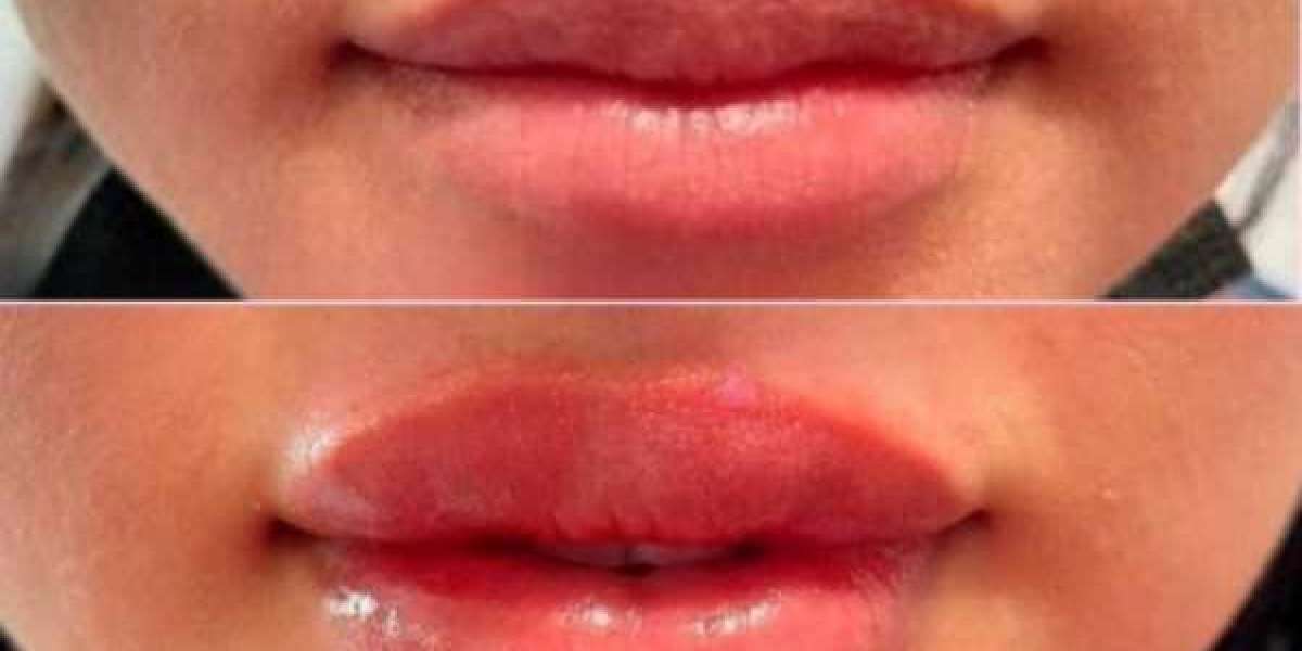 Enhance Your Beauty with Lip Filler in Tucson