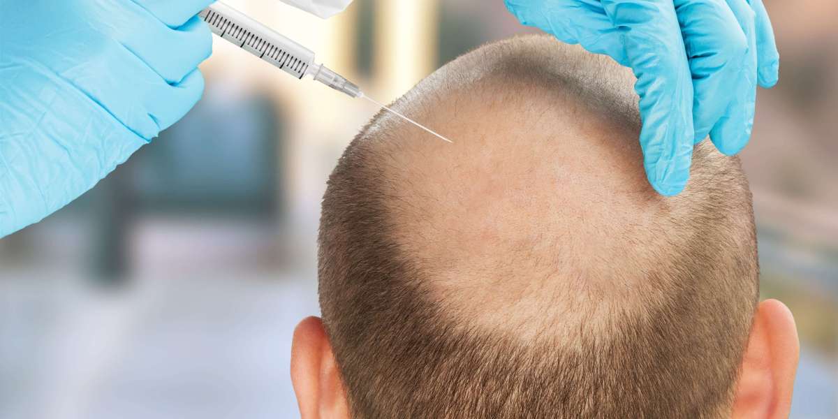 Hair Transplant in Alwar: Your Guide to a Perfect Transformation