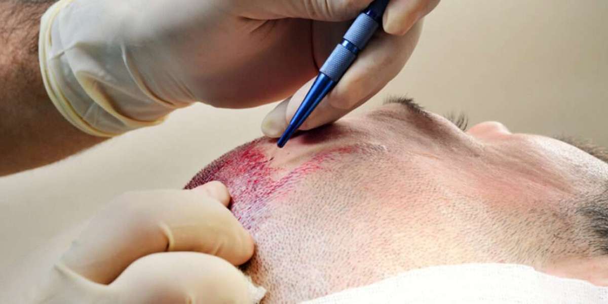 Transform Your Hair with Expert Hair Transplant Services in Mumbai