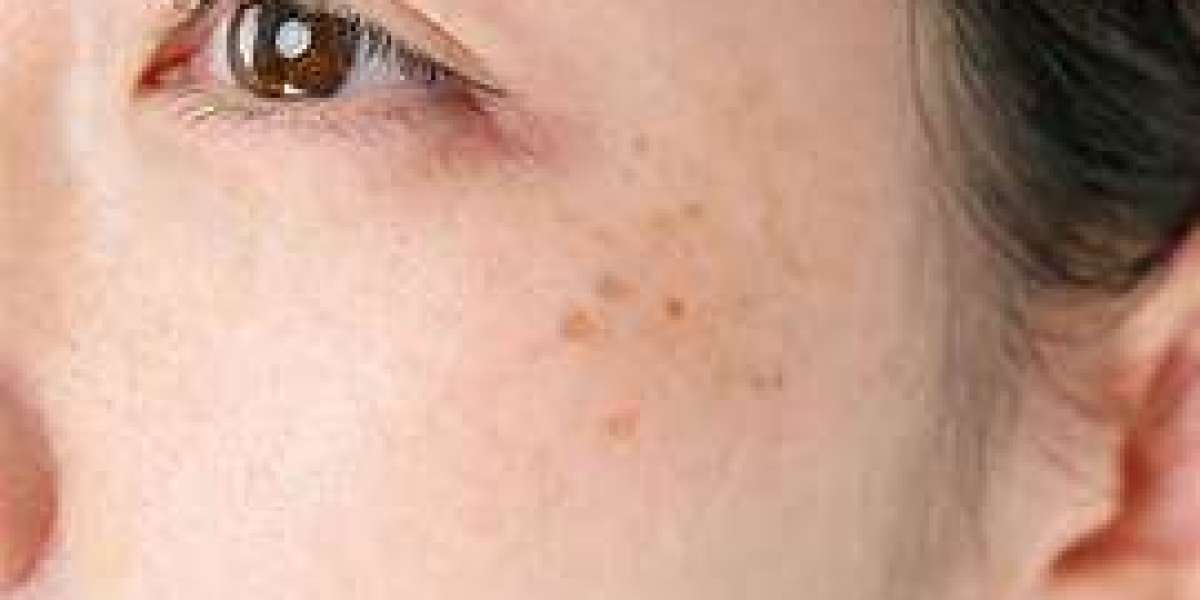 Hyperpigmentation Market Analysis, Epidemiology, Trends and Forecast 2024-2034