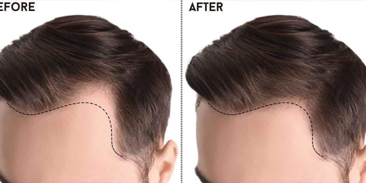 Follicular Renaissance: The Art and Science of Hair Transplants in Islamabad