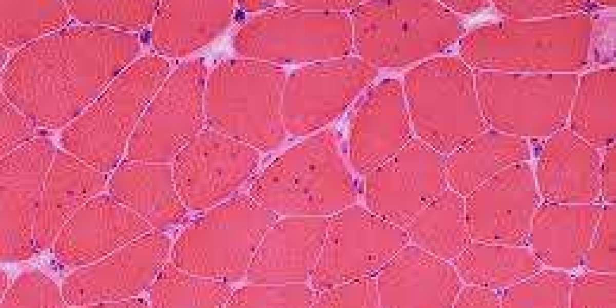 Myelodysplastic Syndrome Market Size, Growth, Industry Trends and Forecast 2024-2034