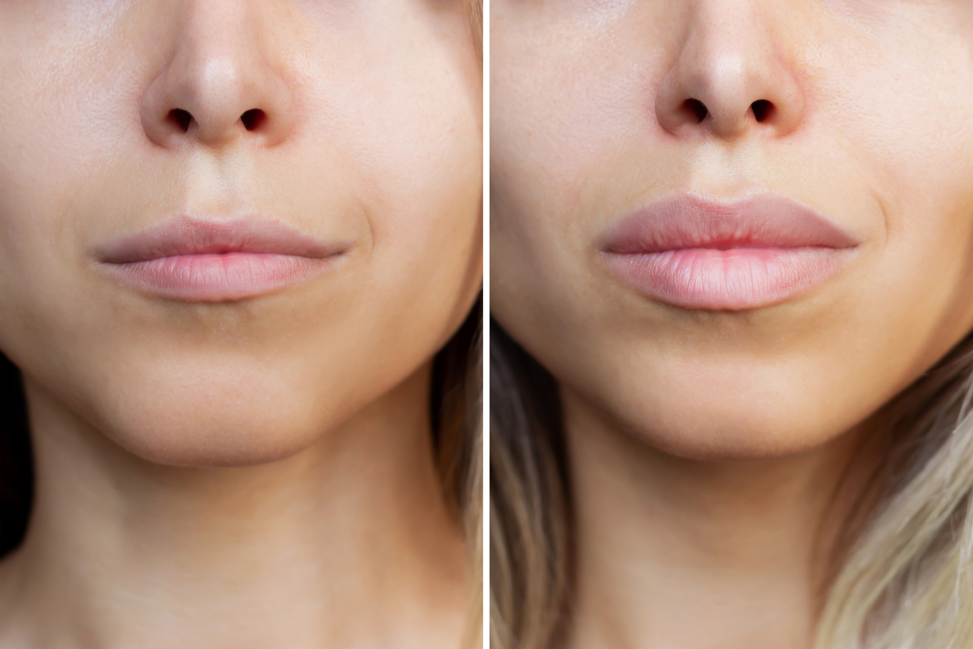 How Natural Looking Lip Fillers Enhance Your Confidence | LogCla.com