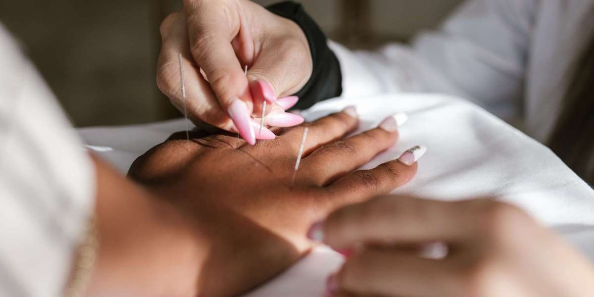 Exploring the Benefits of Acupuncture for Anxiety on Long Island