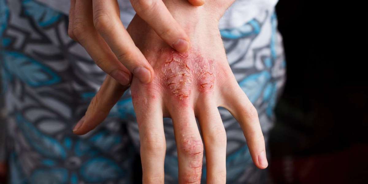 Atopic Dermatitis Market Size, Epidemiology, Analysis & Trends 2034