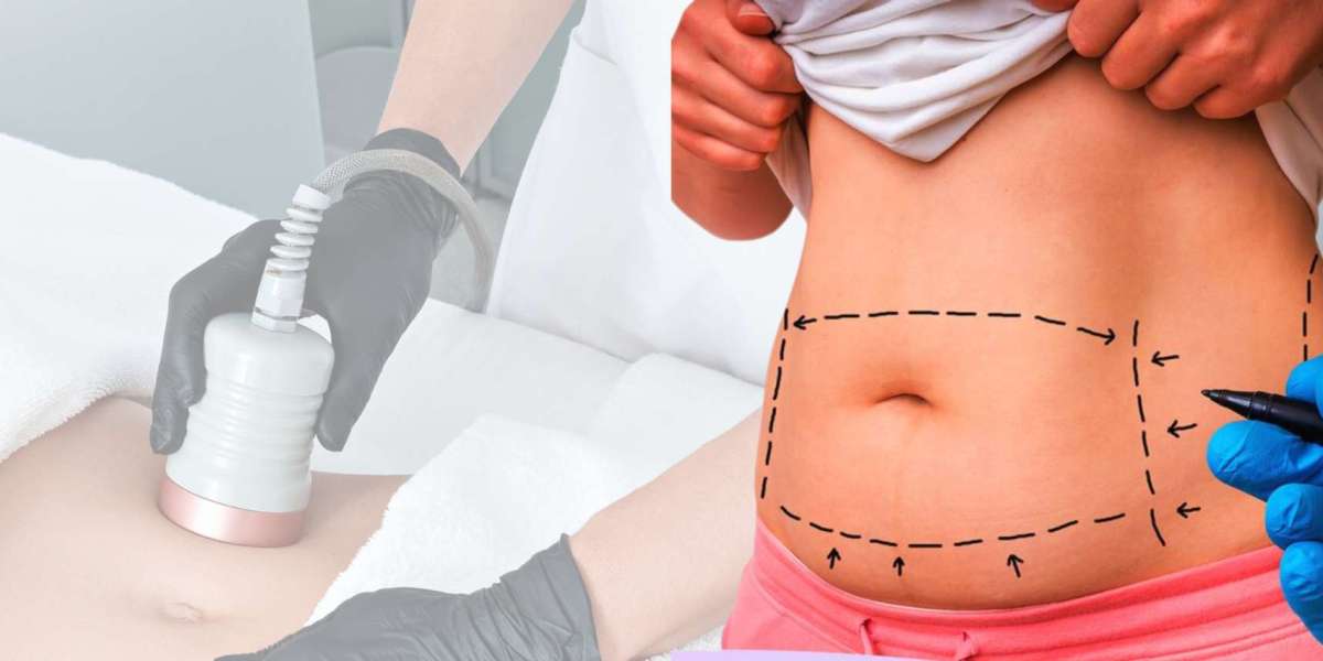 U-Lipolysis Treatment in Mira Bhayandar: A Non-Surgical Solution for Fat Reduction