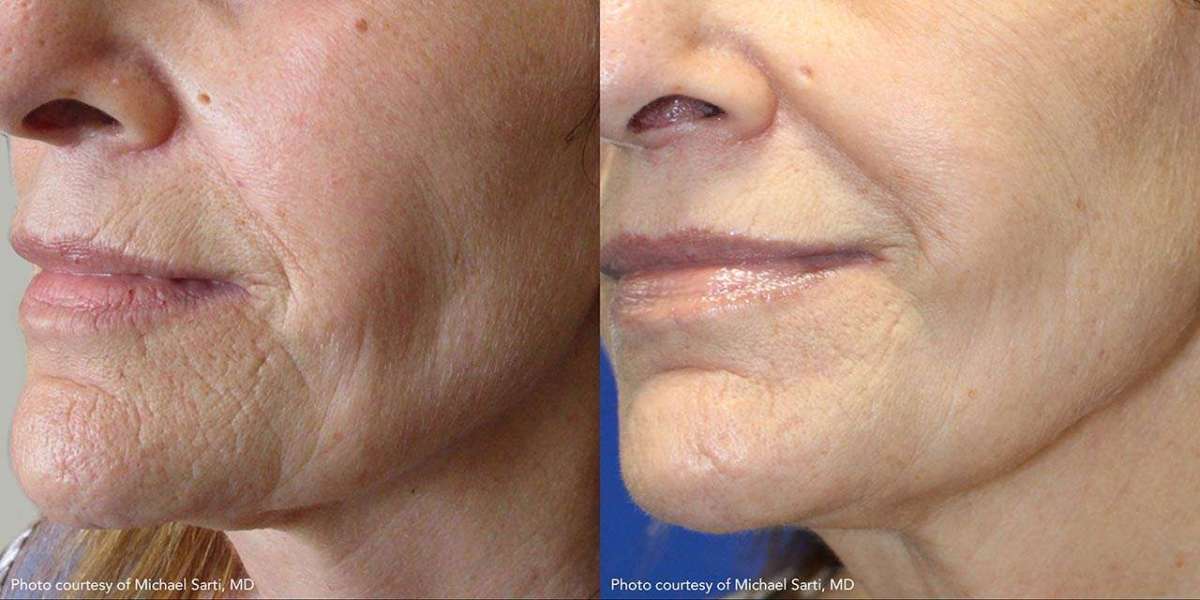 How Microneedling for Skin Tightening Helps with Skin Firmness and Texture