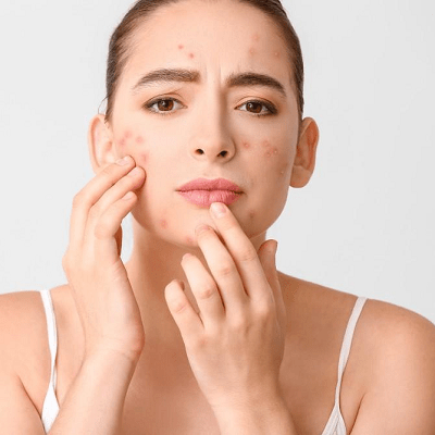 Why Does Glutathione Cause Acne Breakouts in Dubai & Abu Dhabi | Cost